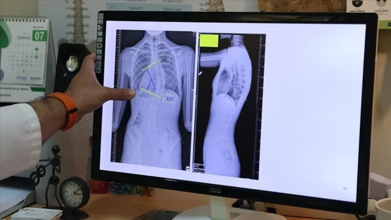 Çocuklarda Skolyoz Tehlikesi! Kıyafetler Uyarı Veriyor!
