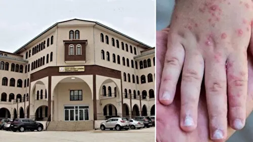 Okulda çiçek hastalığı alarmı: Eğitime ara verildi