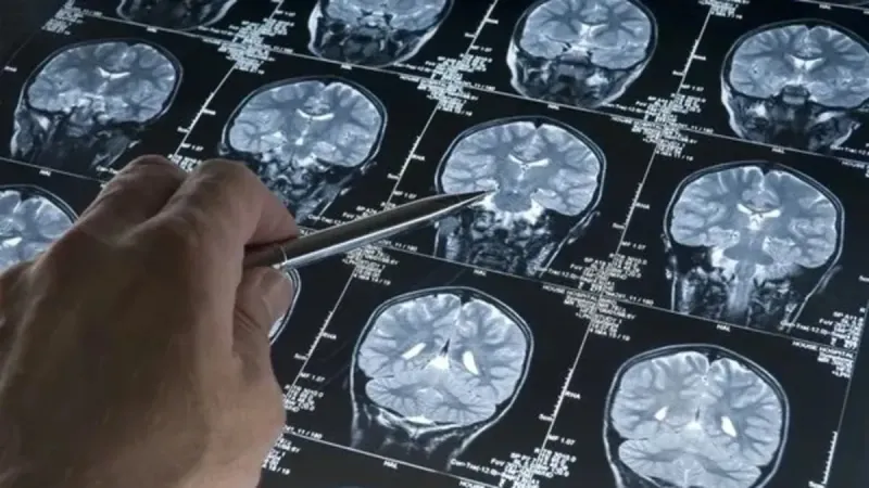 Alzheimer'ı Erken Teşhis Eden Kan Testi! Şok Gelişme